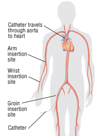VHFC0021_What_is_cardiac_catheterization_image1.png